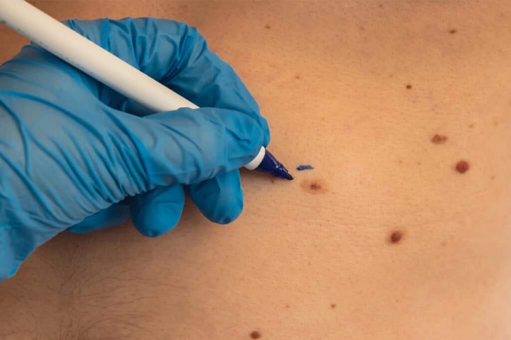 doctor in medical gloves paint lines around male birthmarks preparing procedure for medical